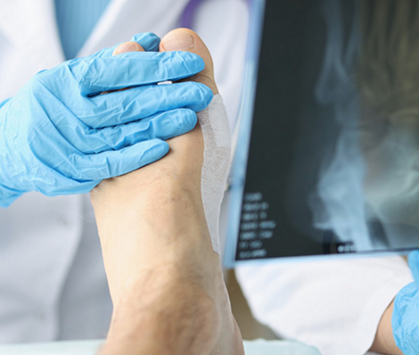 Diabetic Foot Care and Charcot Foot Reconstruction