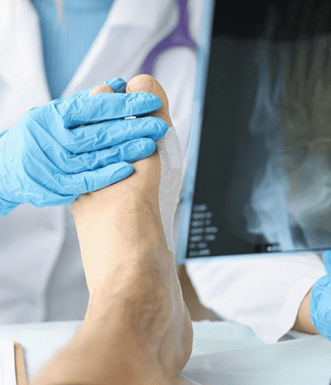 Diabetic Foot Care and Charcot Foot Reconstruction