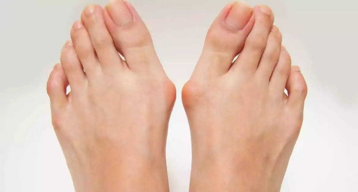 Foot Deformities