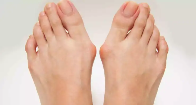Bunion and Toe Deformity Correction