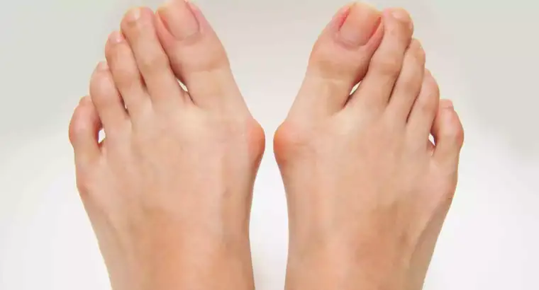 Bunion and Toe Deformity Correction